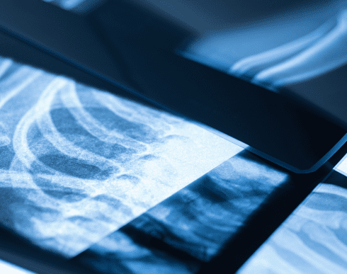 rentgen yakist zobragen