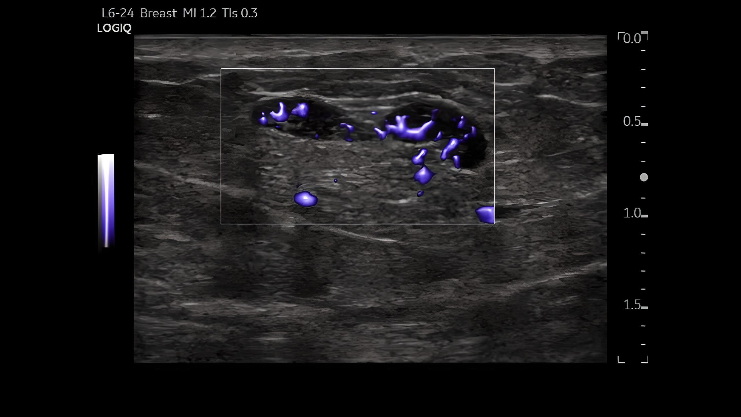 Micro Vascular Imaging of Breast Lesion, L6-24-D Режим MVI, мікроваскулярізація, новоутворення