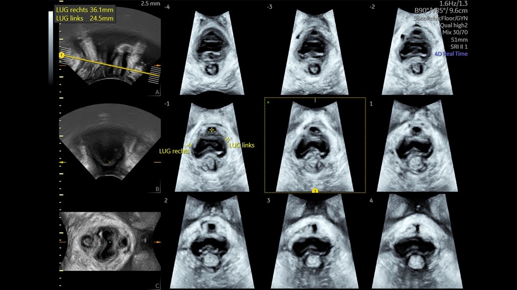 SonoPelvicFloor Спростіть та пришвидшіть оцінювання органів тазового дна за допомогою автоматичного вирівнювання площини та автоматизованих вимірювань