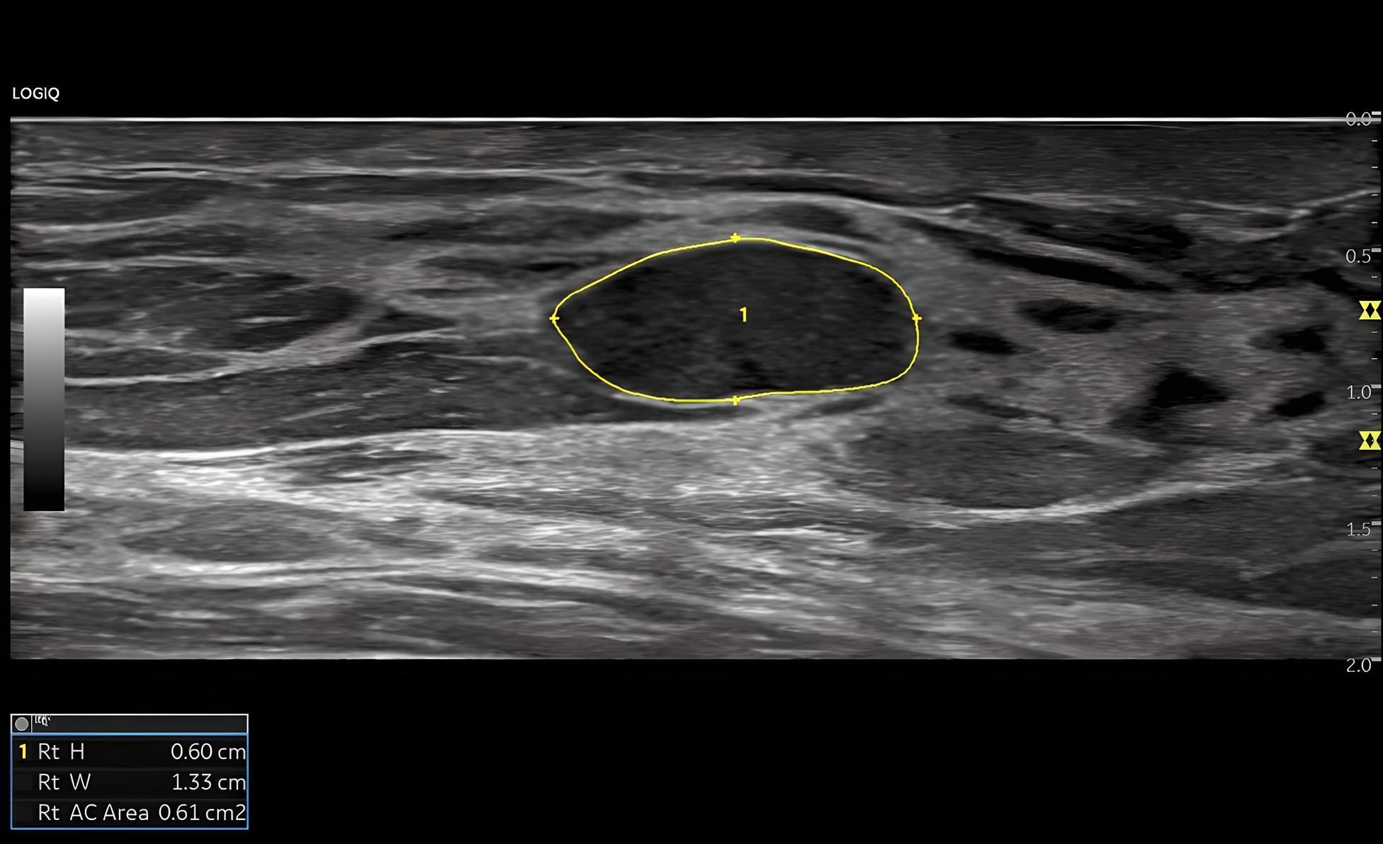 Auto Lesion Segmentation Breast Автоматичні вимірювання, ураження грудей, датчик ML6-15-RS