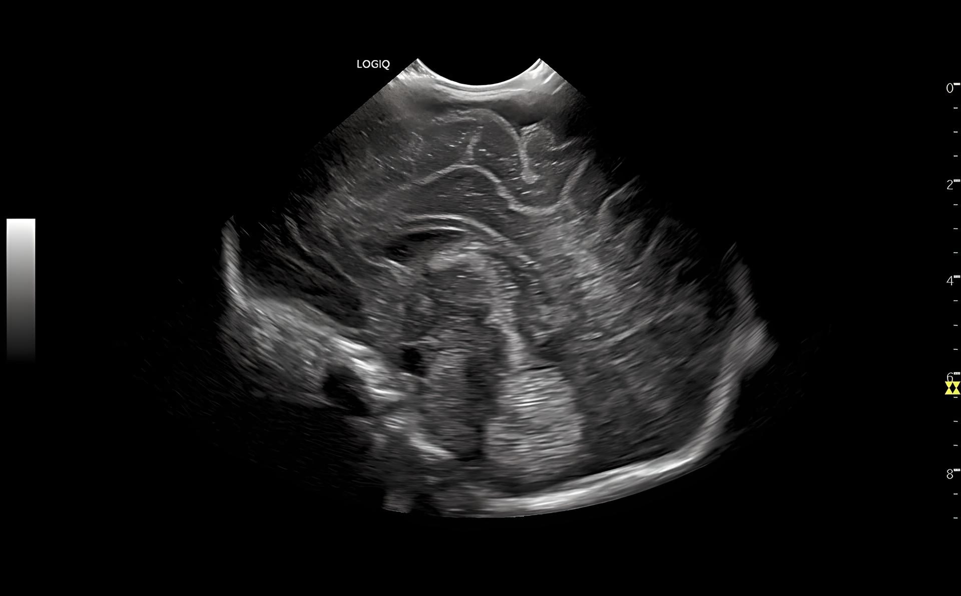 Neonatal Head B-Mode, C3-10-D