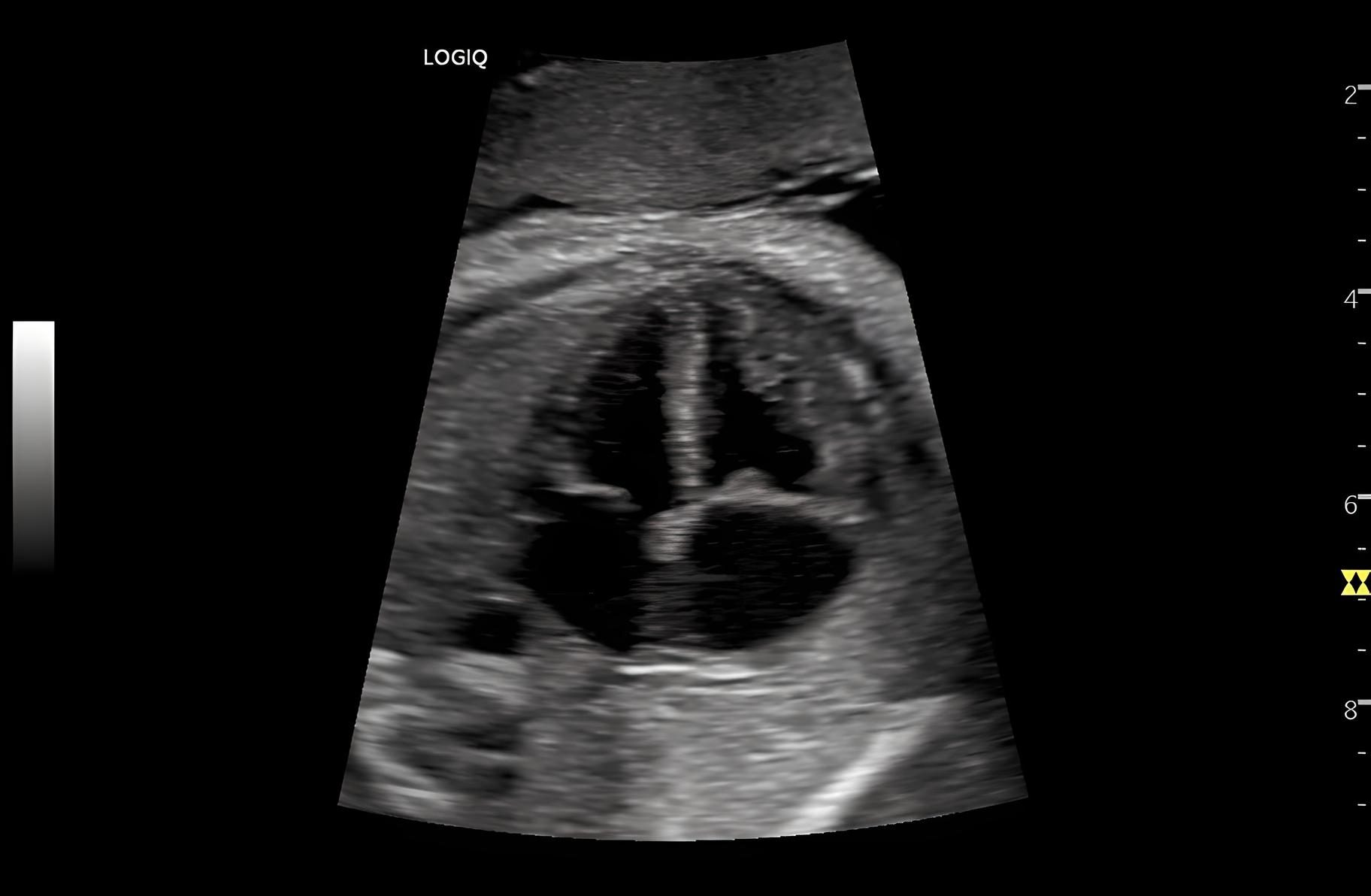 Obstetric 4CH B-Mode Серце плода, датчик C1-6-D