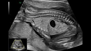 Легкі та кишківник плода на 16 тижні