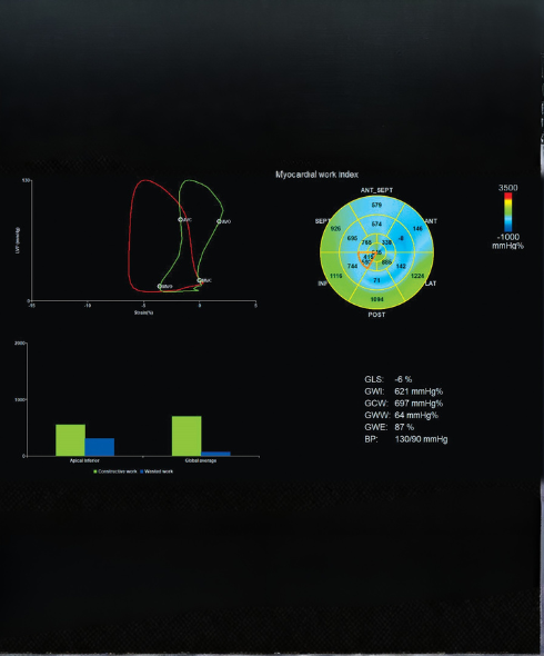 Myocardial Work