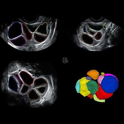 SonoAVCfollicle™ — автоматизоване відстежування та аналіз фолікулів