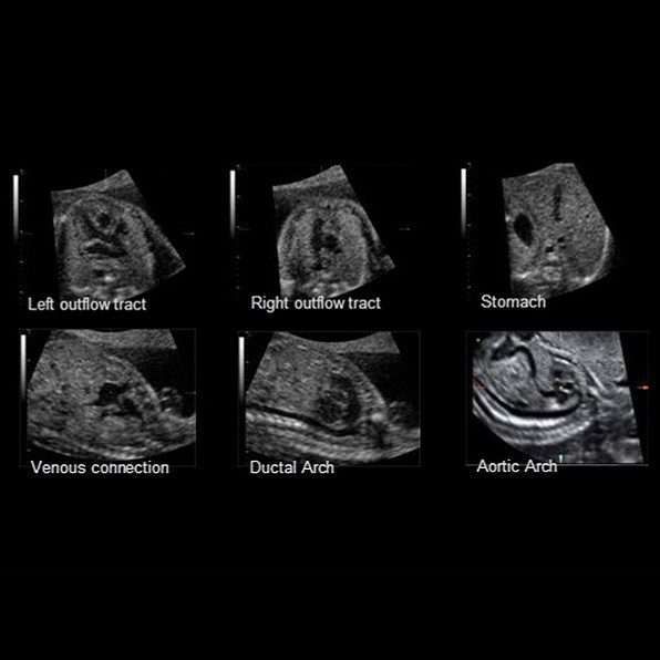 SonoVCADheart™ спрощує процес ультразвукової діагностики серцевих вад