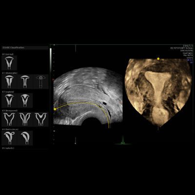 Uterine Trace забезпечує легкість отримання коронарного зрізу матки за три прості кроки в 3D