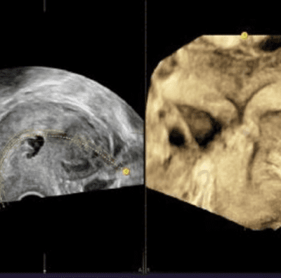 Септова матка відобразжена за допомогою Uterine Trace