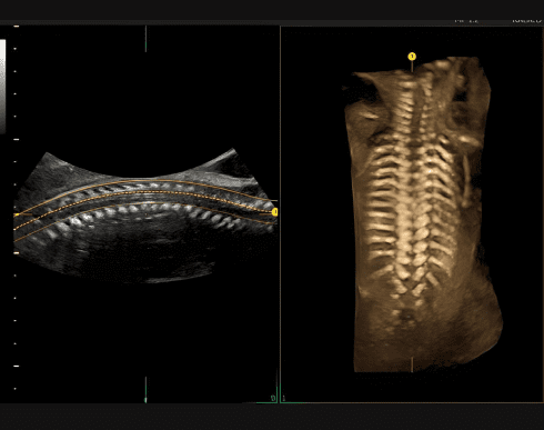 Spine Trace Просо та легко отримуйте складні 3D зрізи. Просто намалюйте хребет, і система автоматично створить коронарний зріз