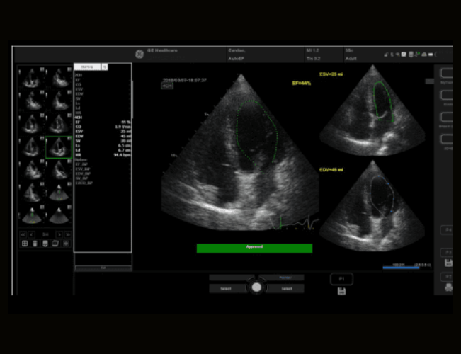 Функція Auto Ejection Fraction