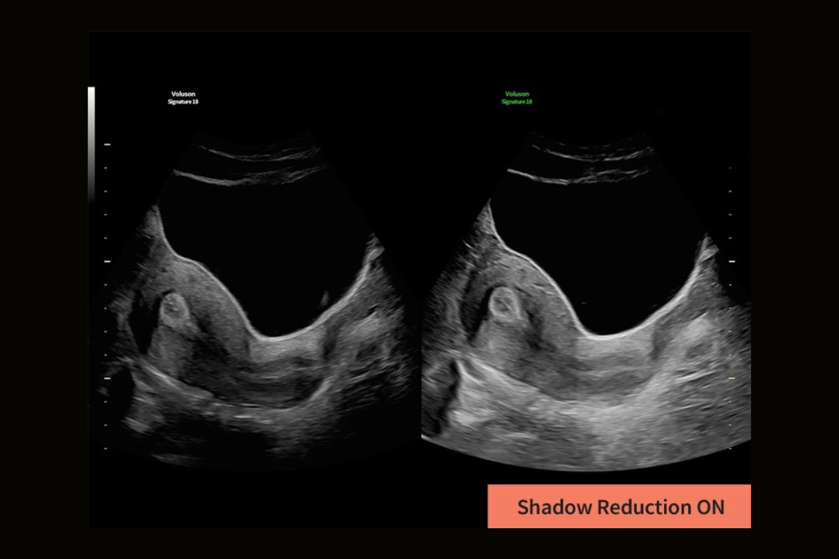 Shadow reduction