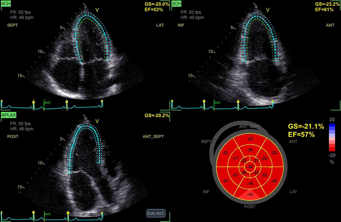 Strain Echo
