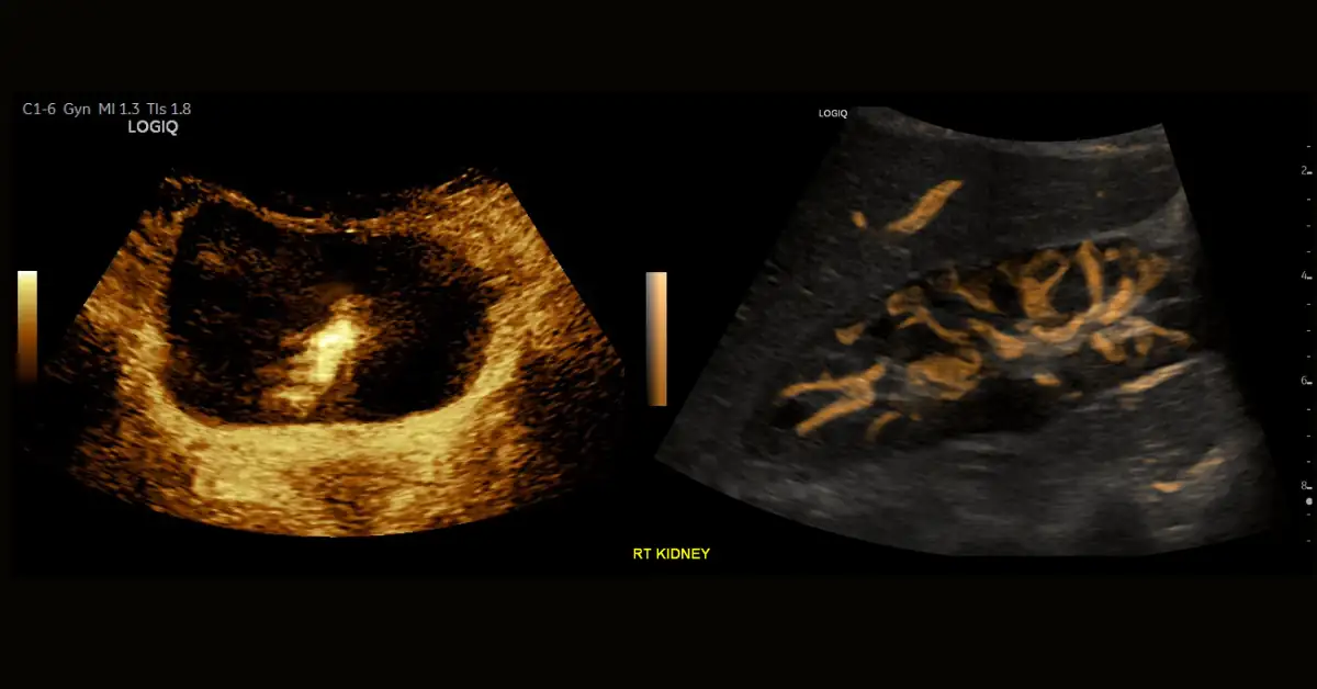 B-Flow Imaging у системах Versana GE HealthCare для оцінки кровотоку в урології